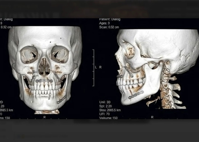 From Botox To $35,000 Jaw Surgery: The Extreme Procedures Promoted At A Looksmaxxing Camp