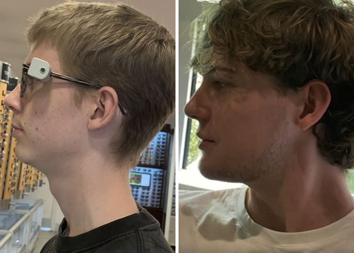 From Botox To $35,000 Jaw Surgery: The Extreme Procedures Promoted At A Looksmaxxing Camp