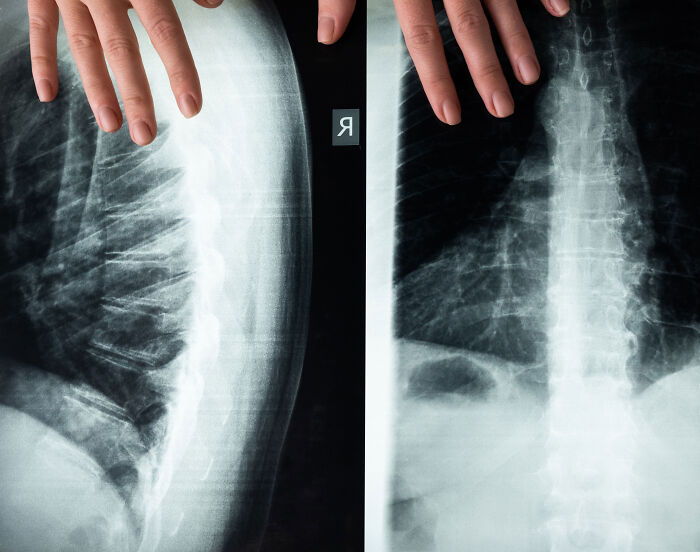 Husband Breaks Silence After Breaking 5 Of Wife’s Ribs By Giving Her A Hug Husband Breaks Silence After Breaking 5 Of Wife’s Ribs By Giving Her A Hug